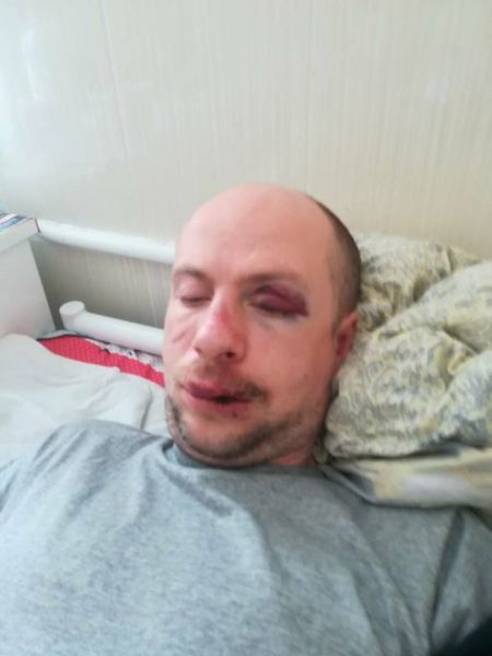 В г. Вишневое Киевской области неизвестны жестоко избили «ветерана» АТО, инвалида 3 группы Александра Рафальского