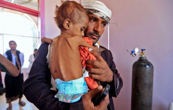 Голод в Йемене, который, по мнению Генсека ООН Антониу Гутерреша, может стать «невиданным» в 2021 году, если финансирование программ помощи этой живущей в состоянии войны стране сократится